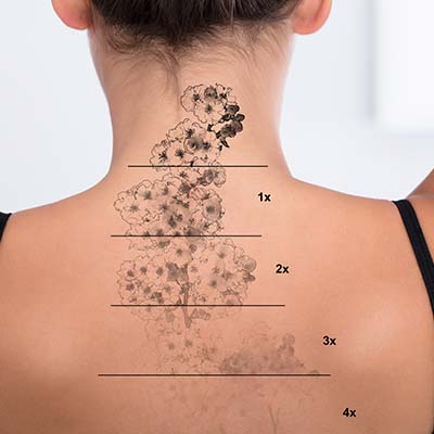 Tattoo Removal Near Me in Dearborn, MI Tattoo Removal Near Me in Dearborn, MI