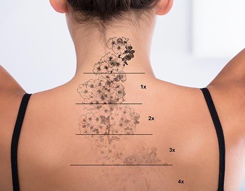 Tattoo Removal Near Me in Dearborn, MI Tattoo Removal